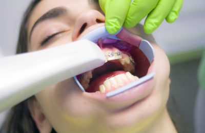 How Much You Should Expect to Pay for Braces